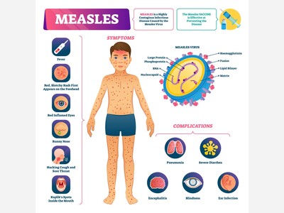 Measles remains a growing concern in Washington as U.S. surpasses 1,100 cases in 2026